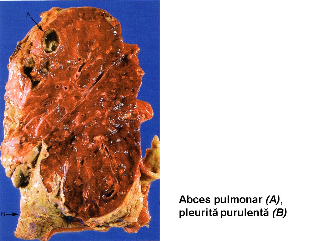 Abces pulmonar (A), pleurită purulentă (B)